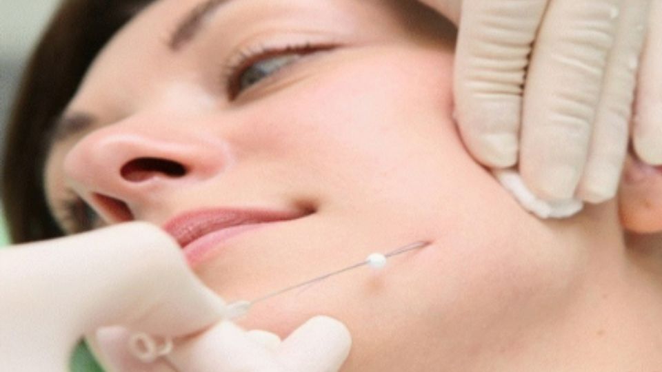 Thread Lift (Tanam Benang)